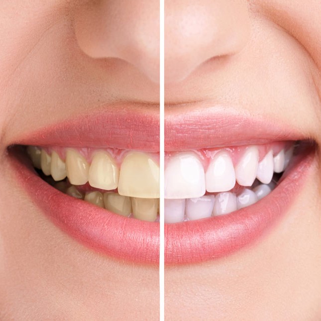 Teeth Whitening Toronto