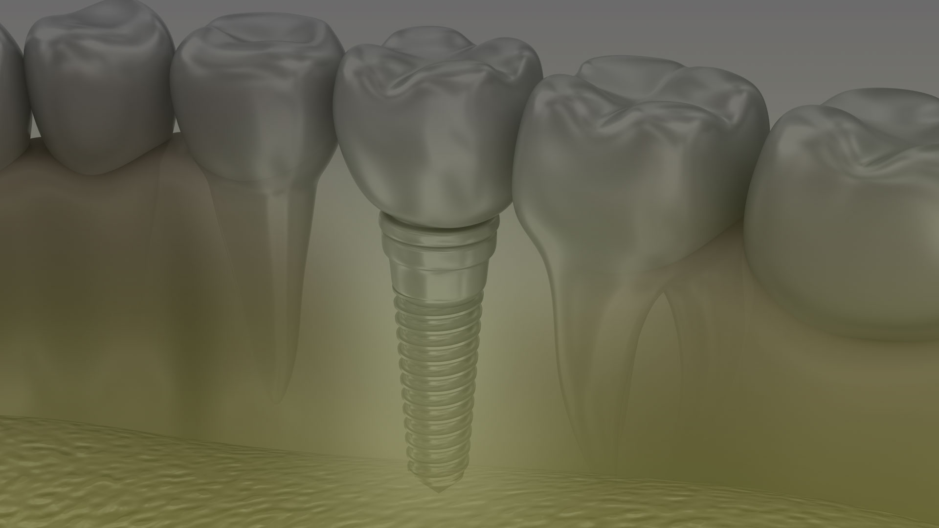 Dental Implants in Toronto