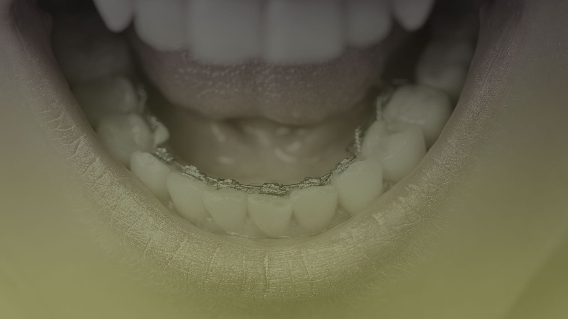 Invisable Braces in Toronto