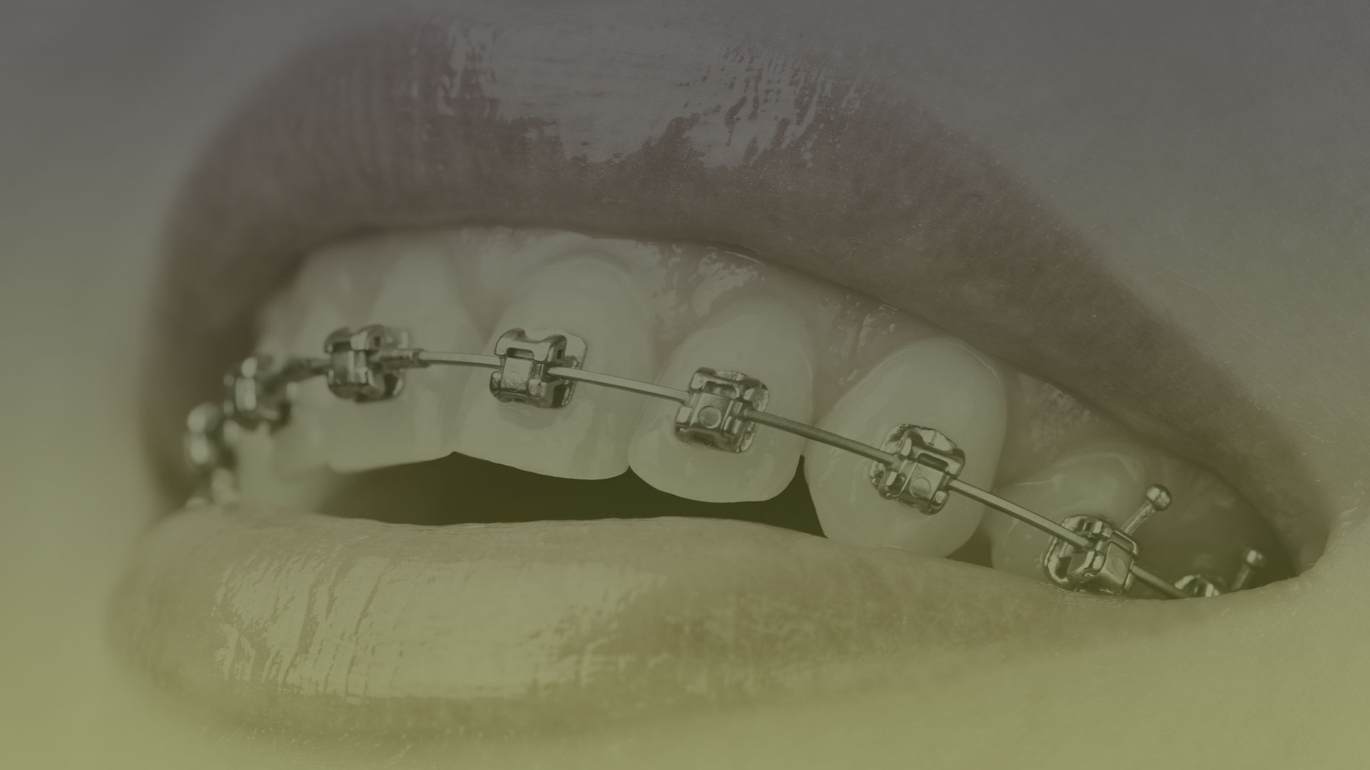 Orthodontic Appliances in Toronto