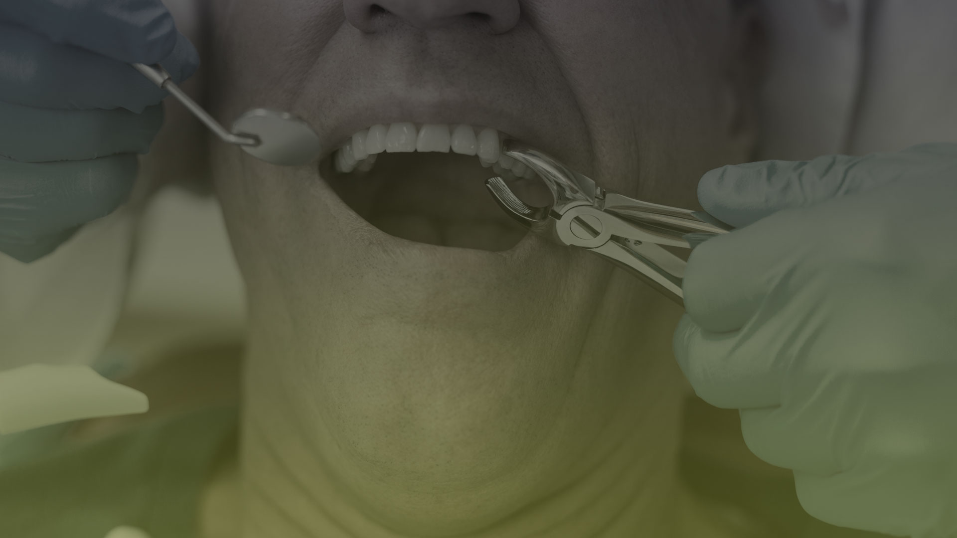 Tooth Extractions Toronto