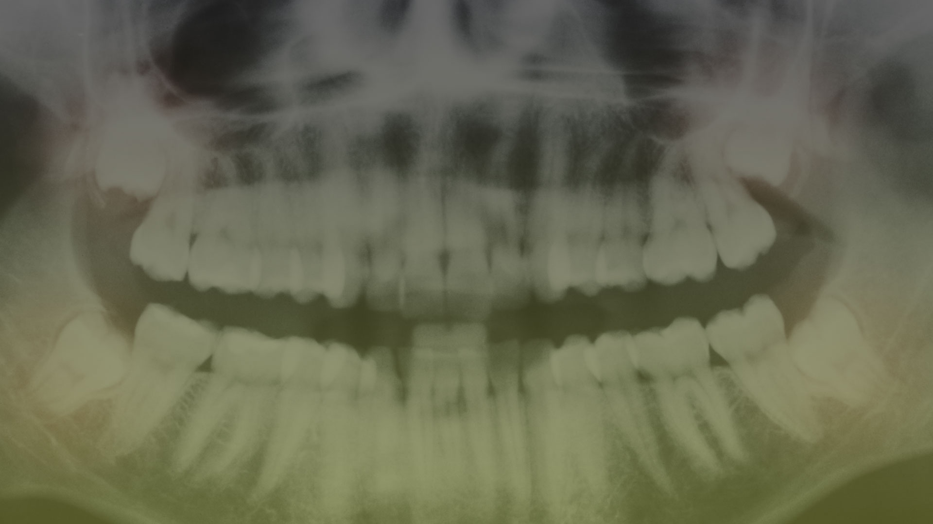 Wisdom Tooth Extractions Toronto