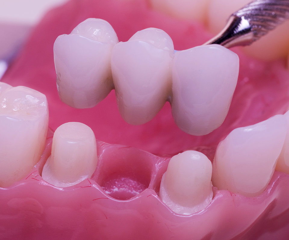 Dental Bridges in Toronto