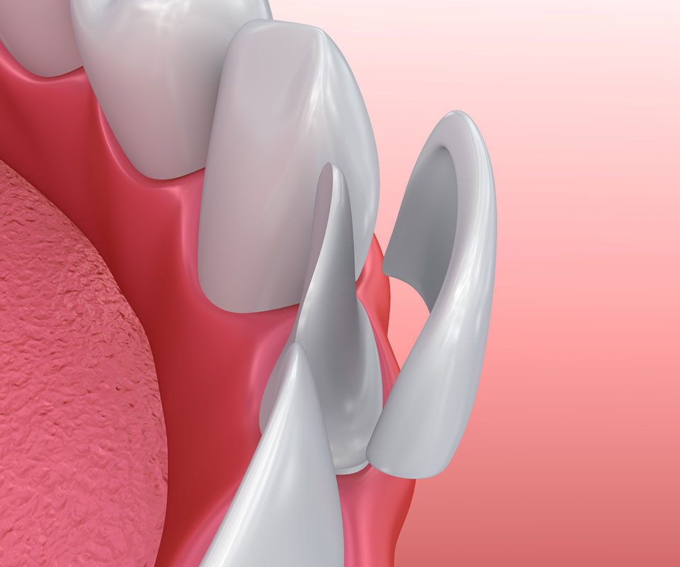 Porcelain Veneers in Toronto