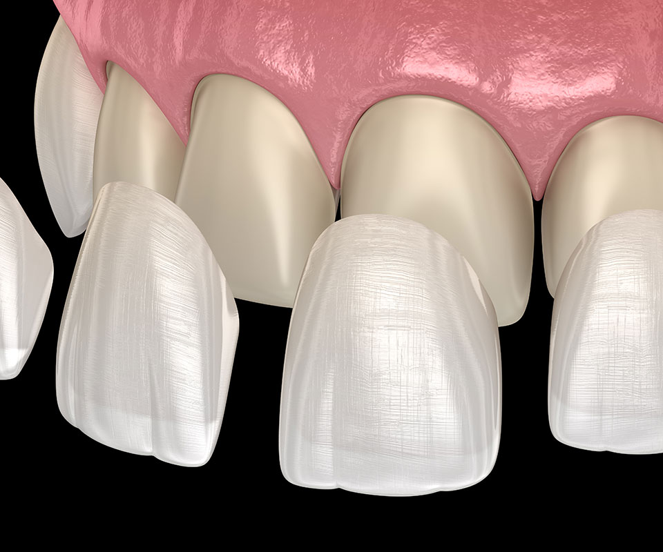 Porcelain Veneers in Toronto