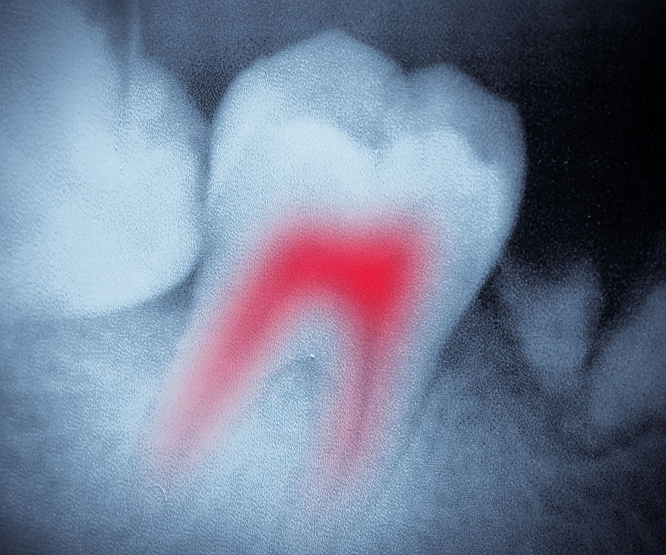 Root Canal Therapy in Toronto