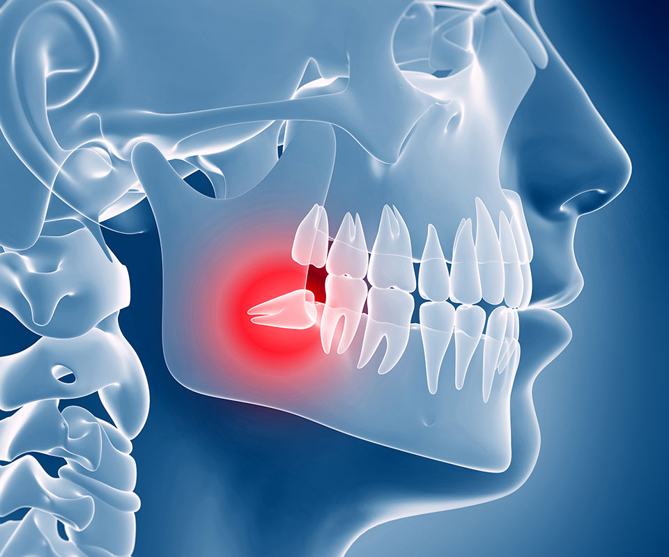 Wisdom Tooth Extractions Toronto
